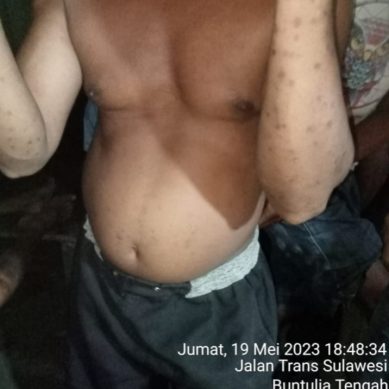 Diduga Dampak Limbah Pertambangan, Sejumlah Warga Buntulia Mengalami Gatal Gatal